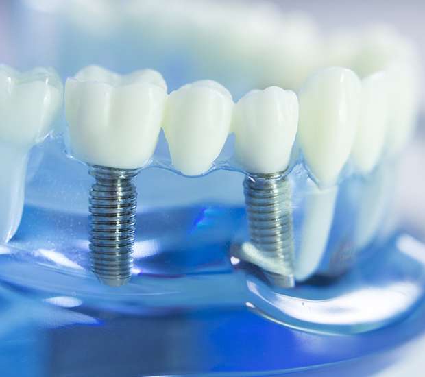 Marina Dental Implants